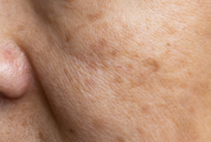 Mujer aplicando rutina despigmentante con activos como vitamina C para eliminar manchas faciales y unificar el tono de la piel.
