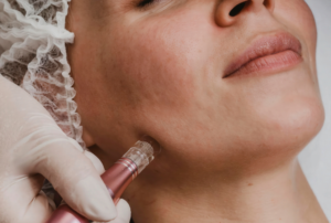 Resultado tras tratamiento facial con exosomas: piel luminosa, firme y rejuvenecida